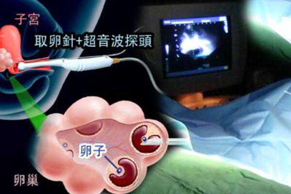 武汉正规渠道捐卵 2023武汉普仁医院试管婴儿价目表 ‘32周双顶径看男女’